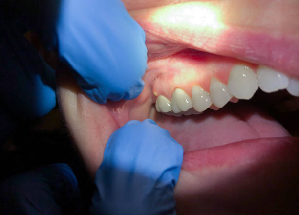 Best Emergency Wisdom Teeth Removal in Walnut Creek, CA